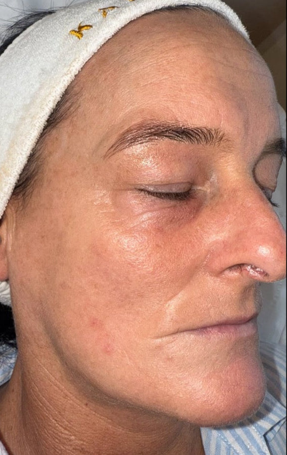 After treatment
