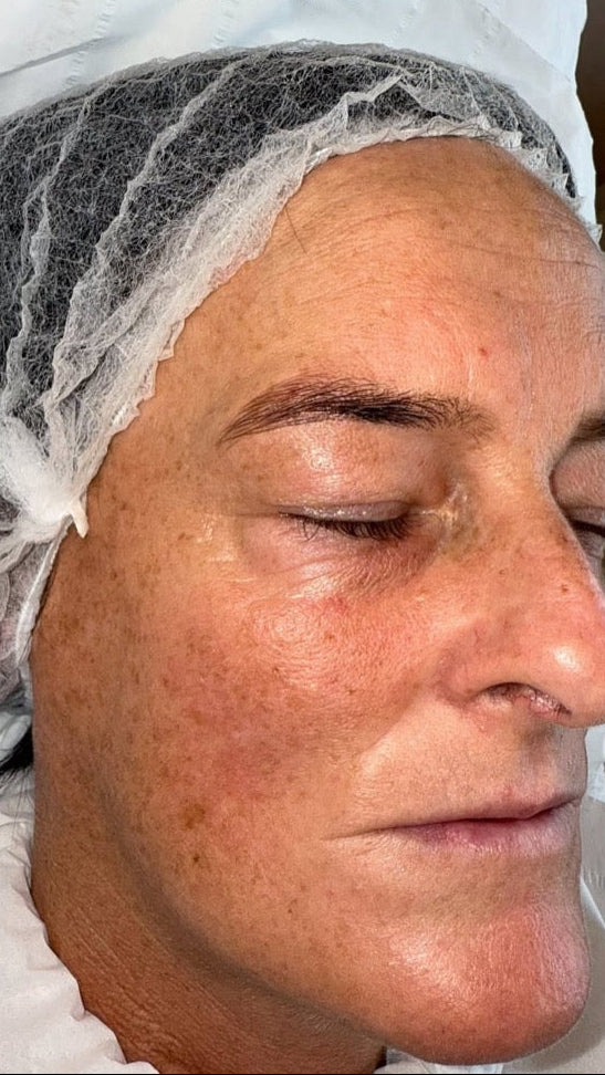 Before treatment
