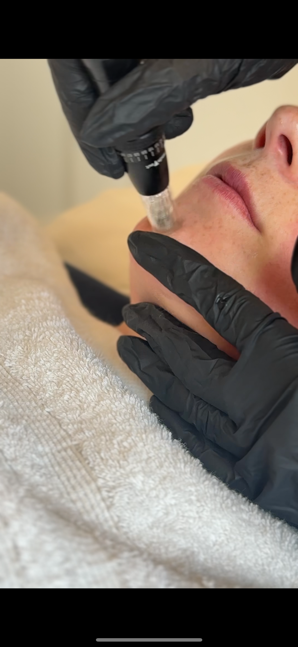 Microneedling – Kaldora